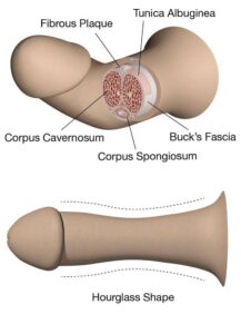 peyronie's disease treatment