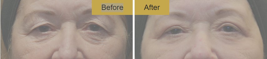 Non surgical blepharoplasty before and after