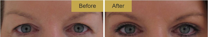 non surgical blepharoplasty treatment result