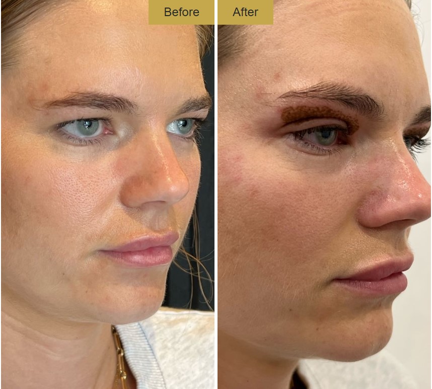Non Surgical Blepharoplasty before and after 