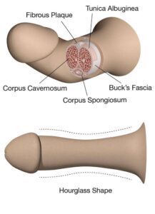 peyronie's disease treatment 