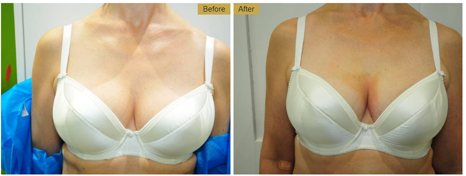 vampire breast lift before and after