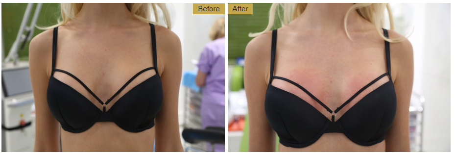vampire breast lift treatment result