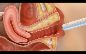 Laser vaginal rejuvenation